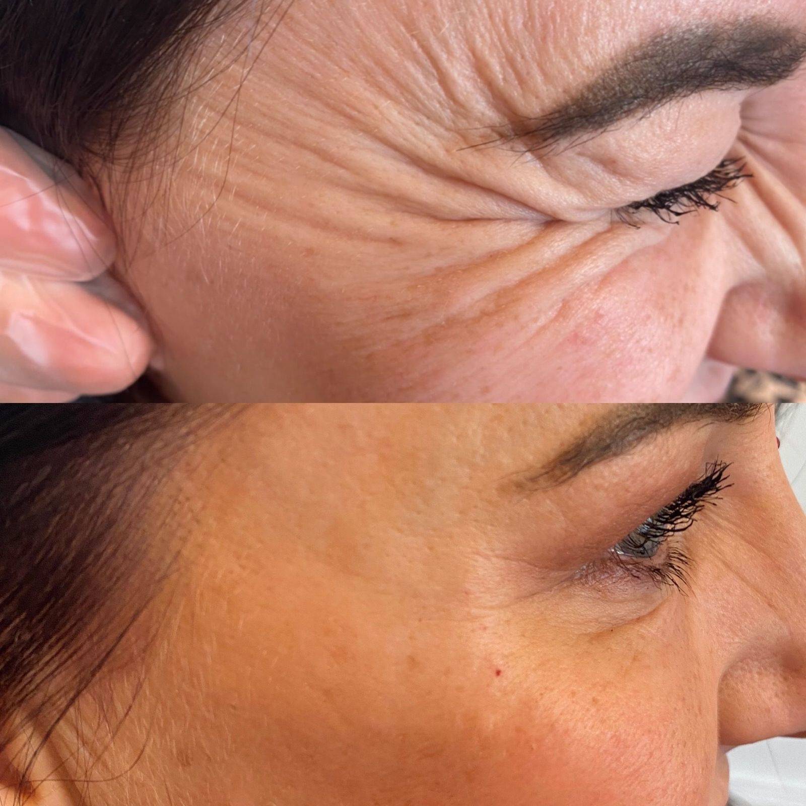 Botox Before and Afters