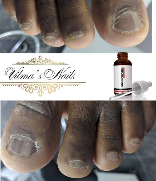 Starting Clearance Solutions drops for Fungal Nail toes