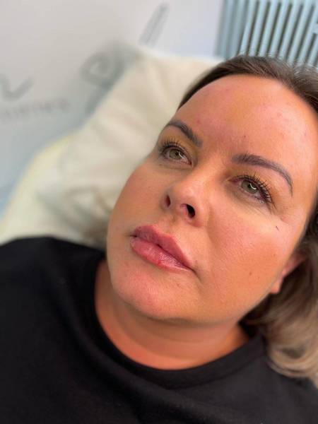 1.1ml Lip Enhancement 