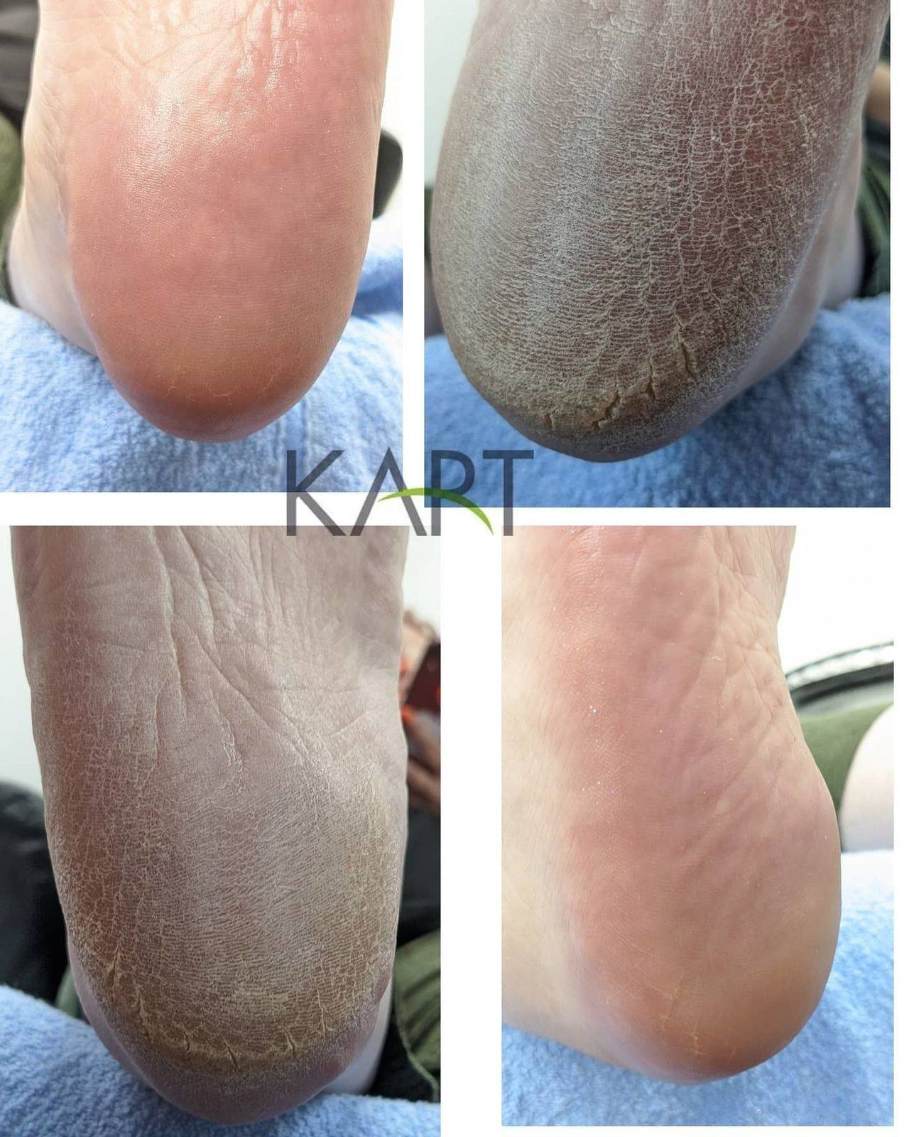 1st Kart Pedicure Treatment