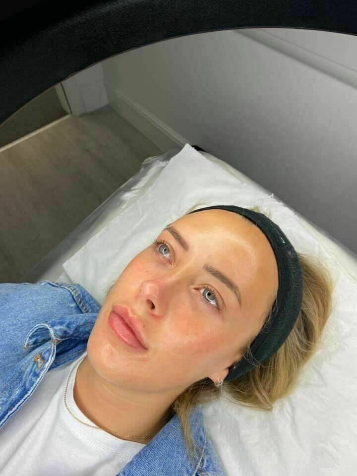 Chemical Peel Deluxe using a glycolic acid peel.