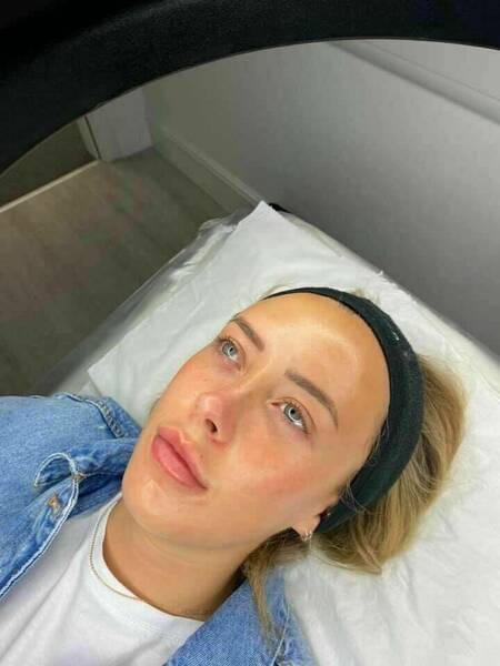 Chemical Peel Deluxe using a glycolic acid peel.