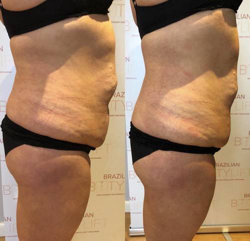 One session of Tummy Sculpt Ultimate 