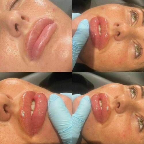 0.5 ml Lip Filler