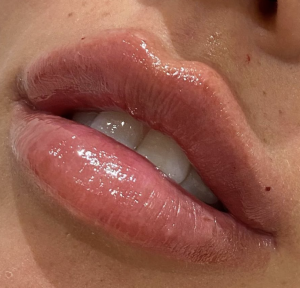1.1ml Lip Enhancement 