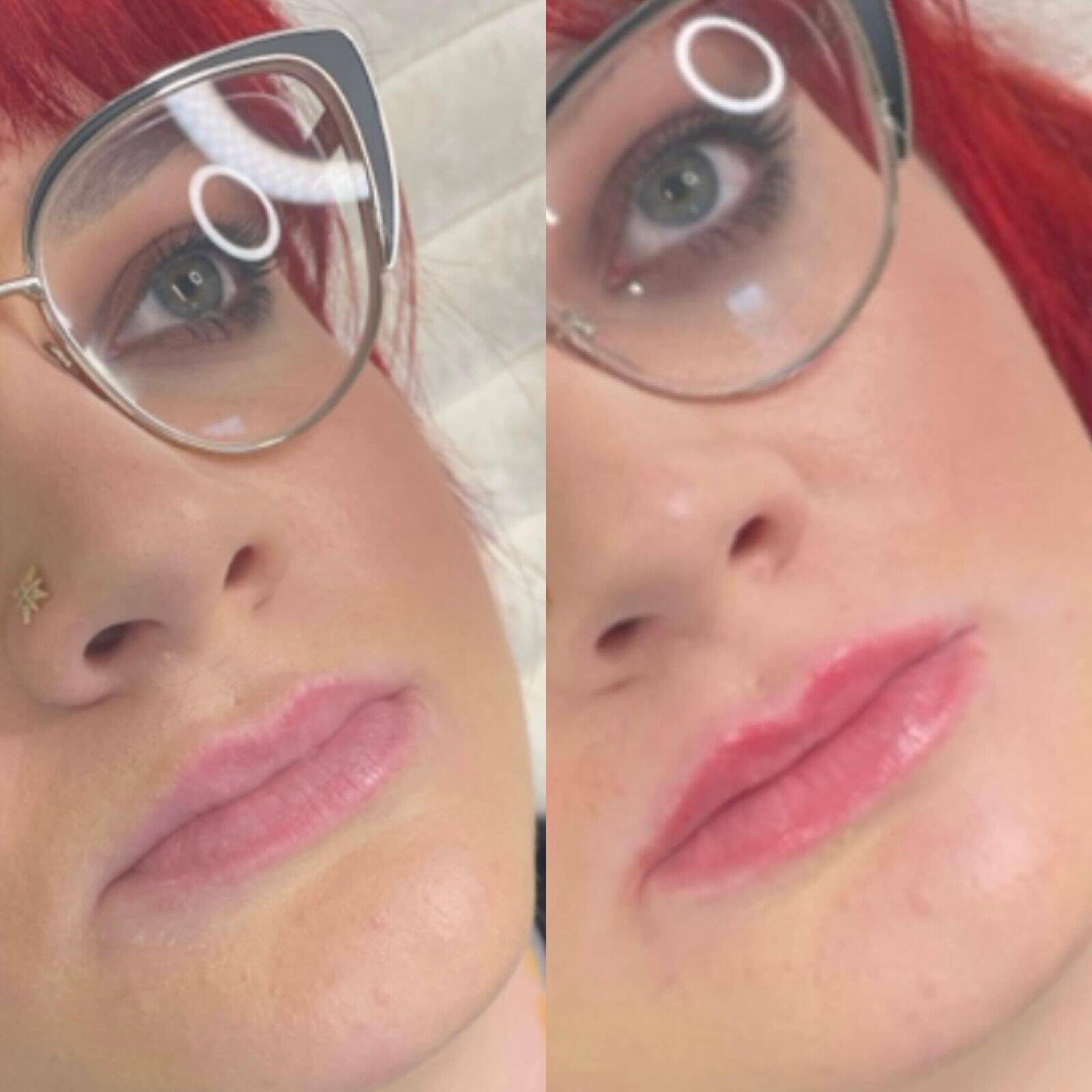 Lip dermal filler 