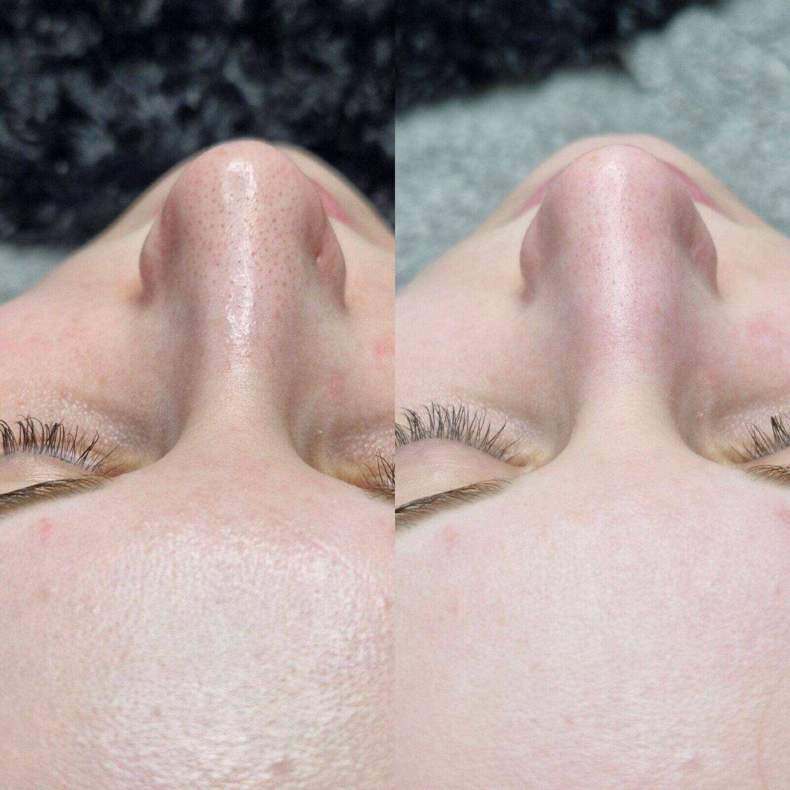 Gesichtsbehandlung Ausreinigung 