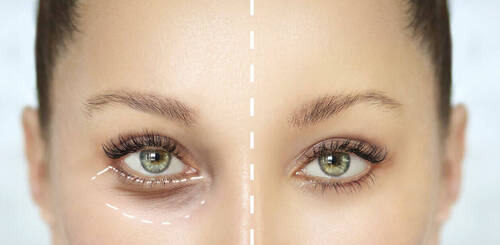 LA RADIOFREQUENCE CONTOUR DES YEUX - cure de 6 soins de 25 min