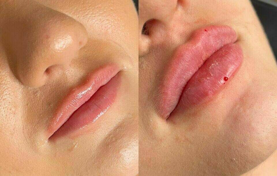 Volumenaufbau mit dem Hyaluron Pen