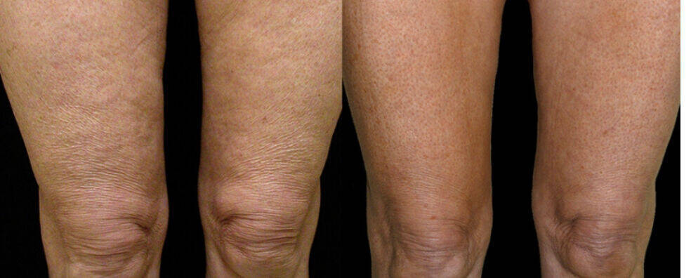 LA RADIOFREQUENCE CORPS - genoux 20 min