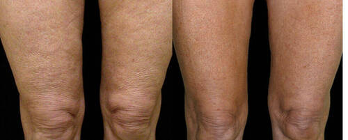 LA RADIOFREQUENCE CORPS - genoux 20 min