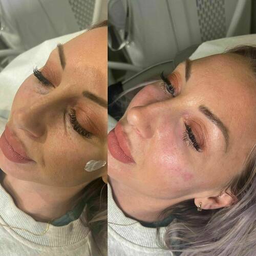 Under Eye Rejuvenation 