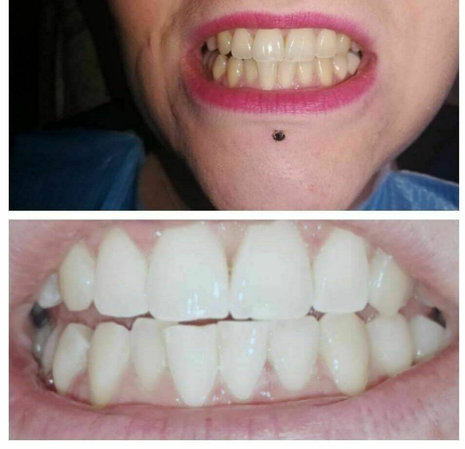 Blanchiment dentaire 