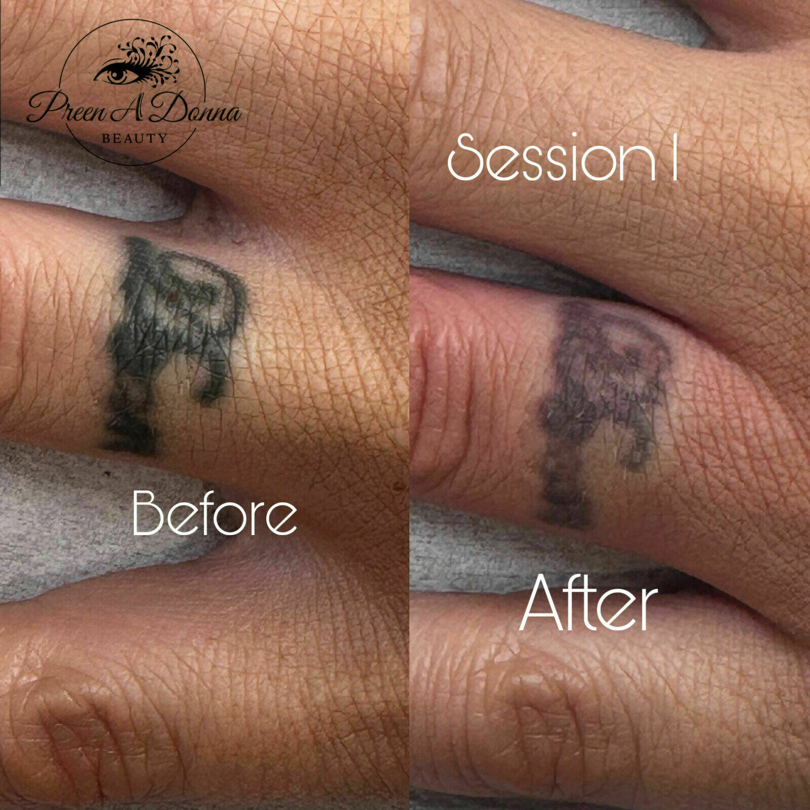 Tattoo removal 