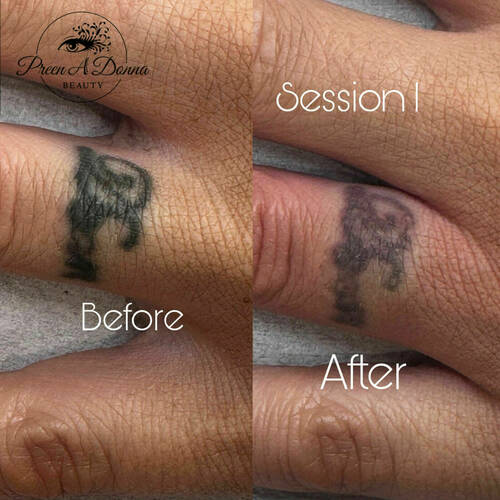 Tattoo removal 