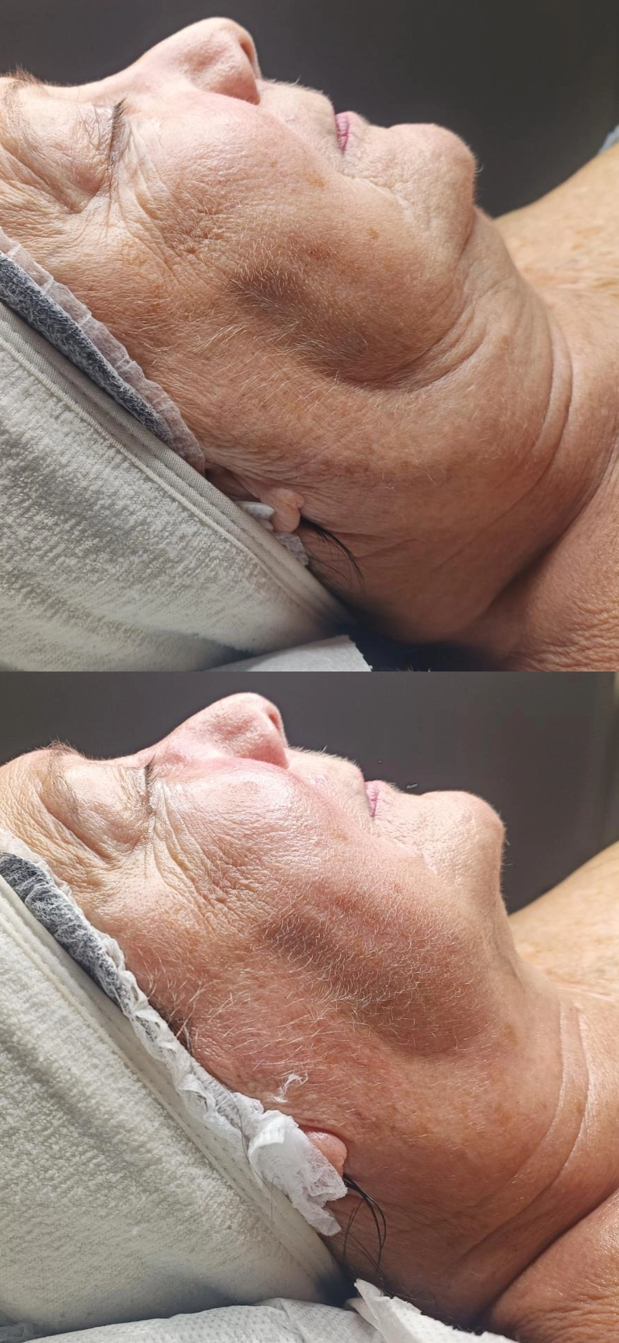 Remodelage Cou et Ovale du Visage