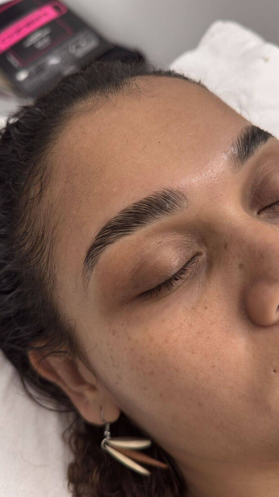 Browlift