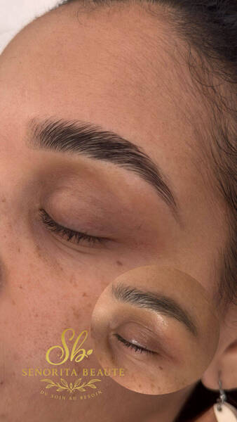 Browlift 