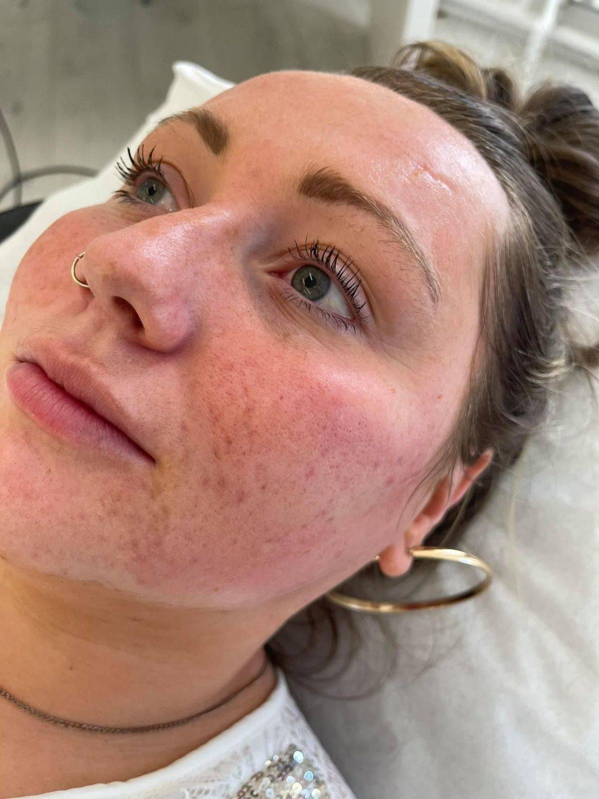 Microneedling Training Day 