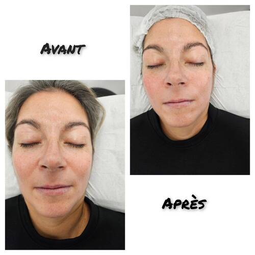 Lifting coréen 2 zones 3 seances