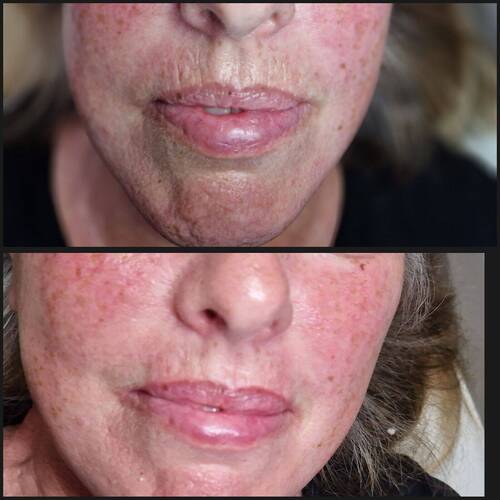 Softening smokers lines