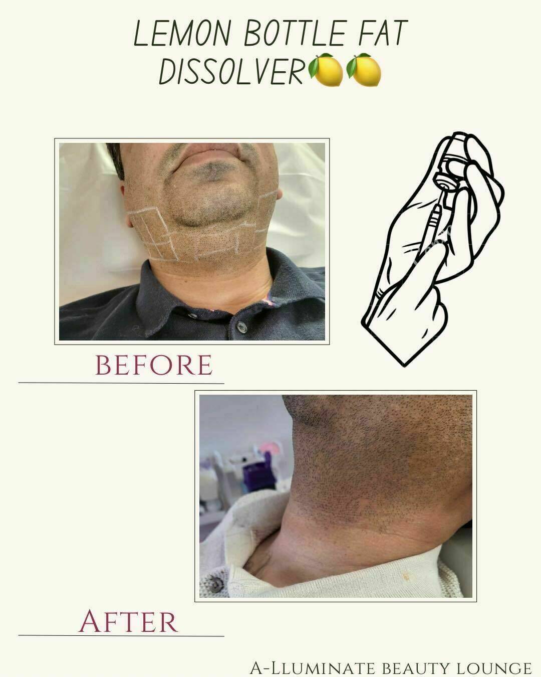 Lemon bottle fat dissolve