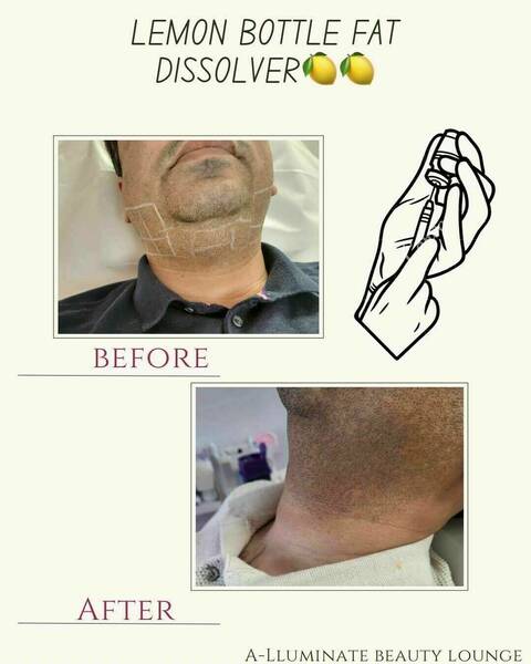 Lemon bottle fat dissolve