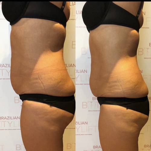 One session of Tummy Sculpt 