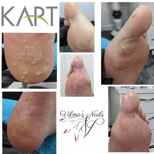 1st Kart Pedicure Treatment and Start using Clearance Fix forte with soap.