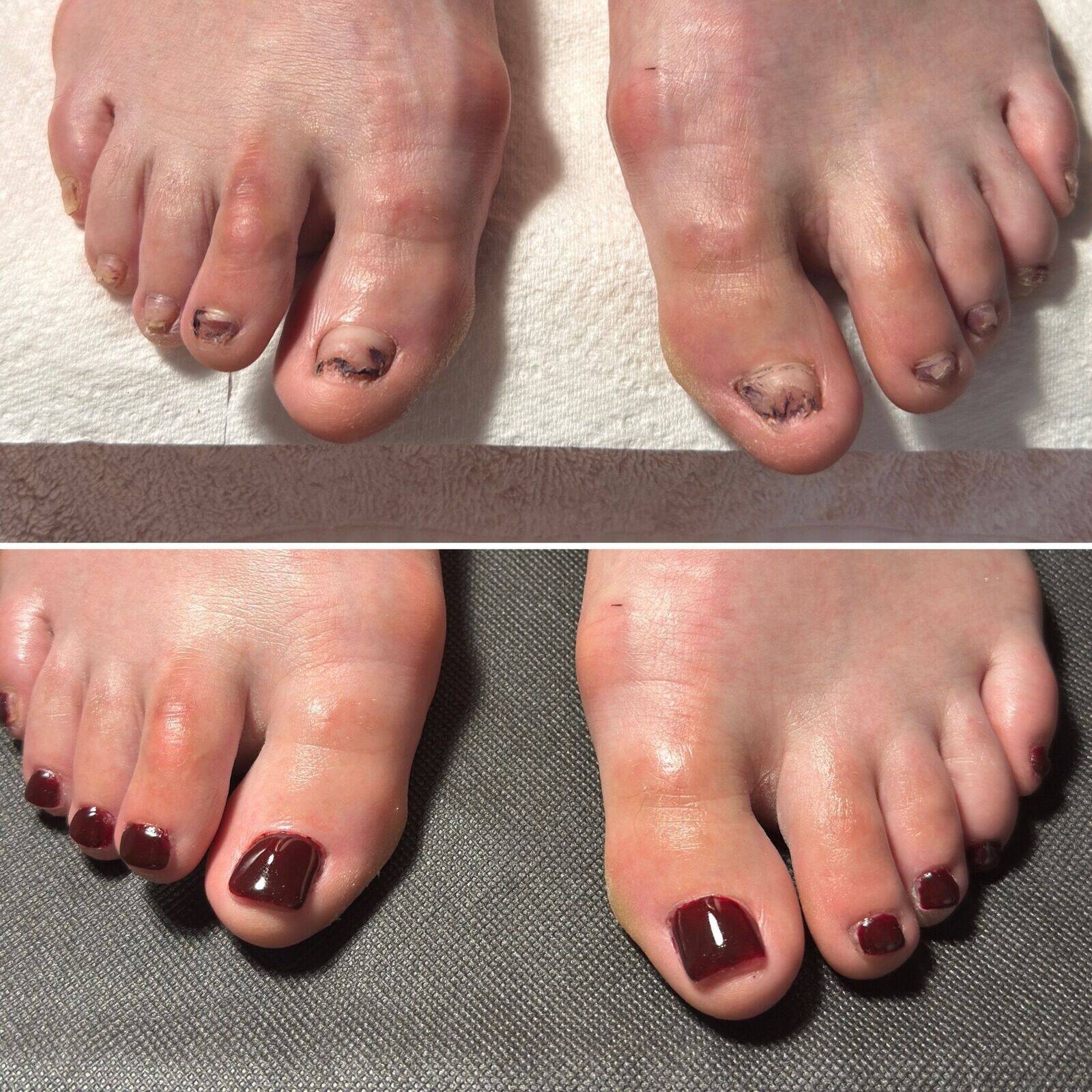 Avant VS Après : Reconstruction ongulaire
