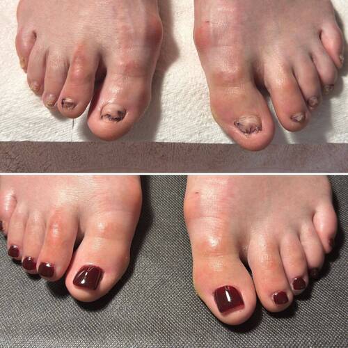 Avant VS Après : Reconstruction ongulaire