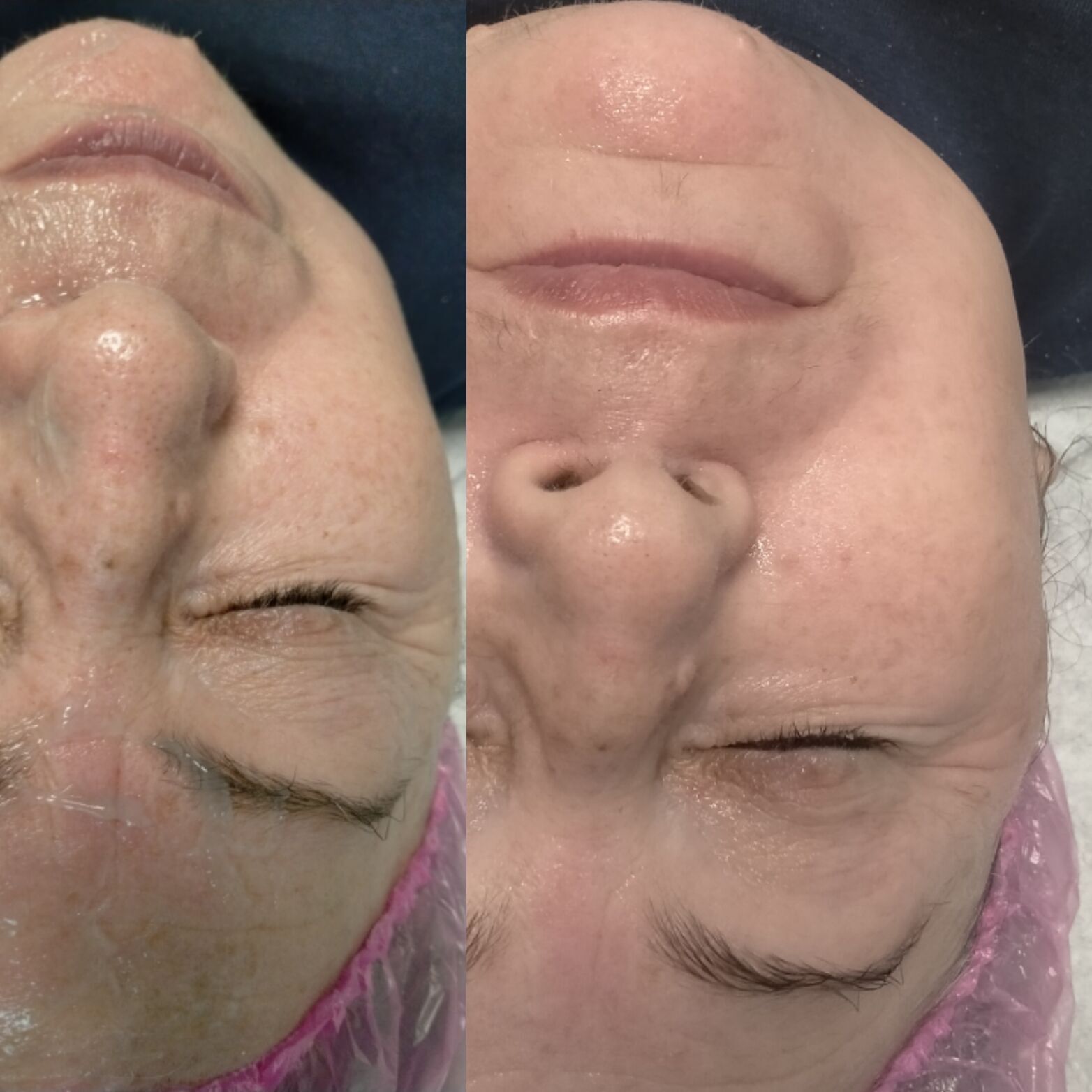 Facialift