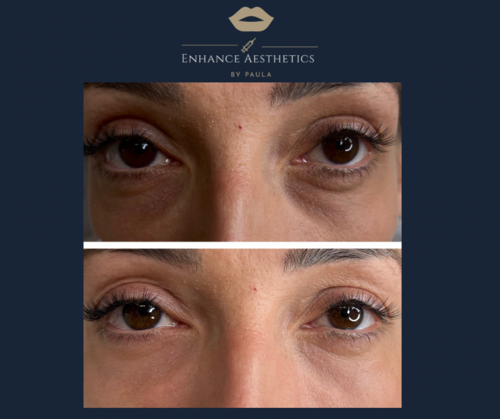 Tear Trough Filler before and after