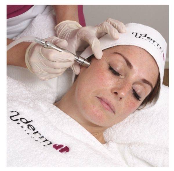 Microdermabrasion 