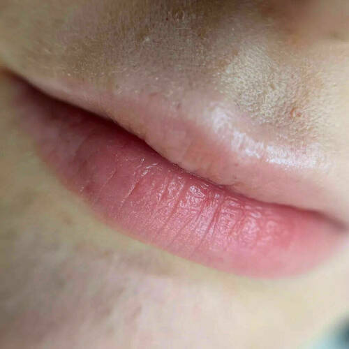 Lippen vor der Behandlung 