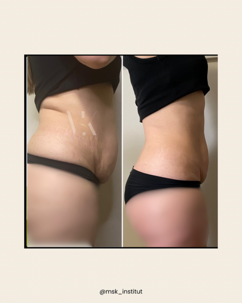 CURE Winback 1 zone (6 séances) 