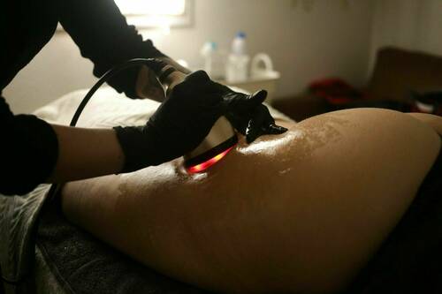 Lipocavitation | Radiofréquence