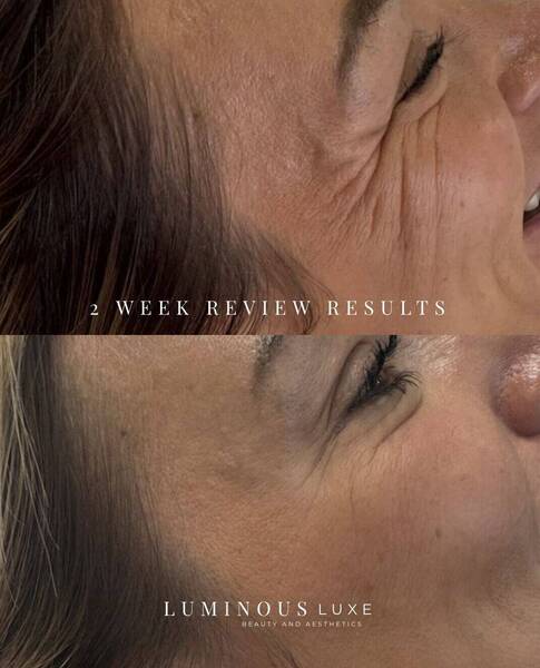 2-week review for my lovely client ✨ Amazing results already, with just a little top-up needed for perfection 💉Fresh, natural, and confidence-boosting! 