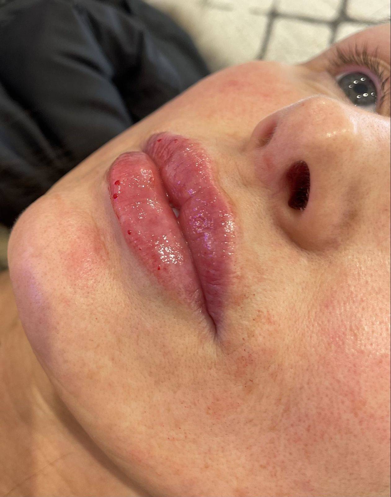 1.1ml Lip Enhancement 