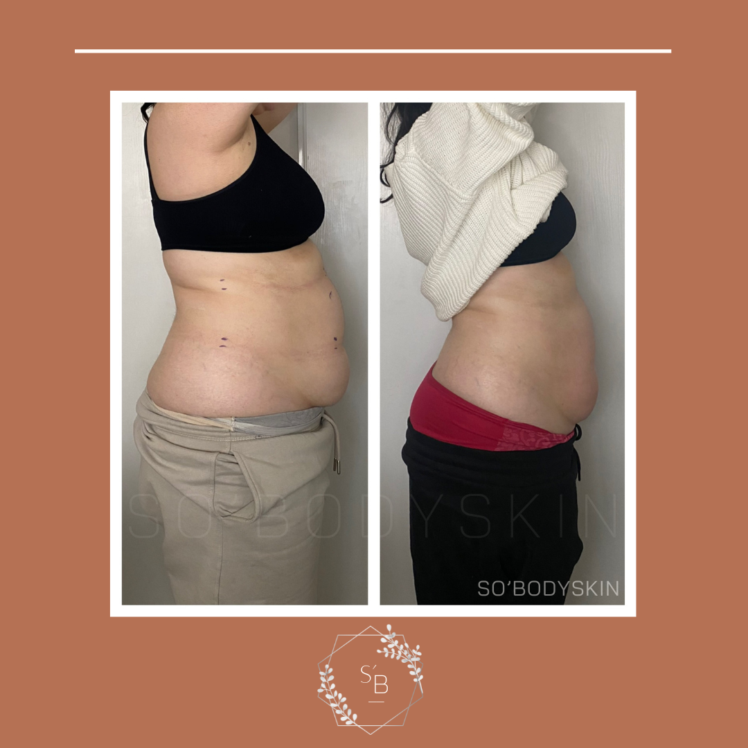 Pack Minceur (Lipocavitation + Radiofréquence) - Résultat en 3 séances