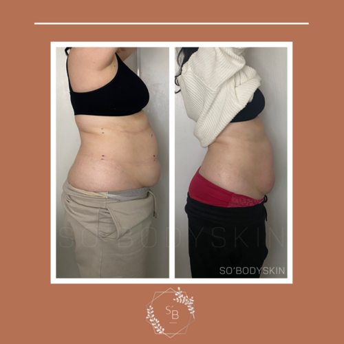 Pack Minceur (Lipocavitation + Radiofréquence) - Résultat en 3 séances