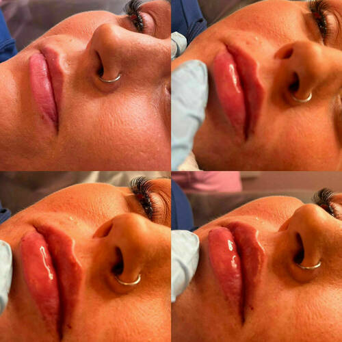 1.1ml Lip Filler