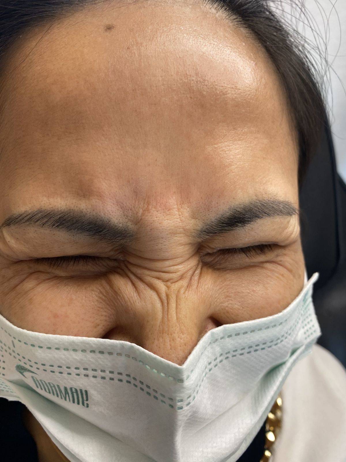 Botox Before and Afters