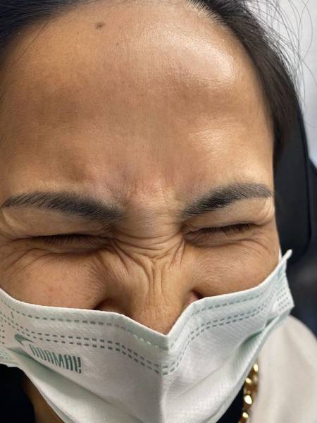 Botox Before and Afters