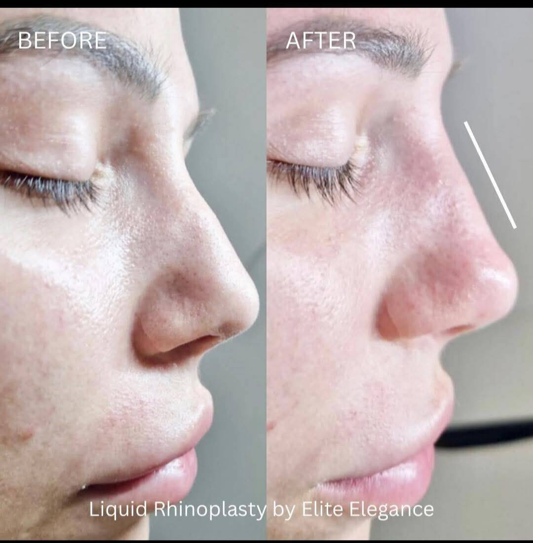 Non-surgical Rhinoplasty 