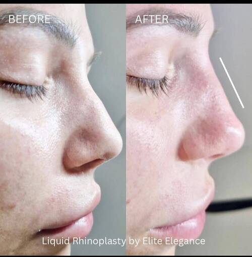 Non-surgical Rhinoplasty 