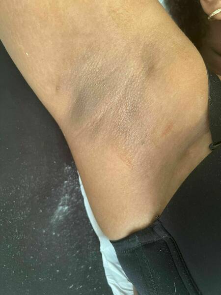 Épilation aisselles #apres