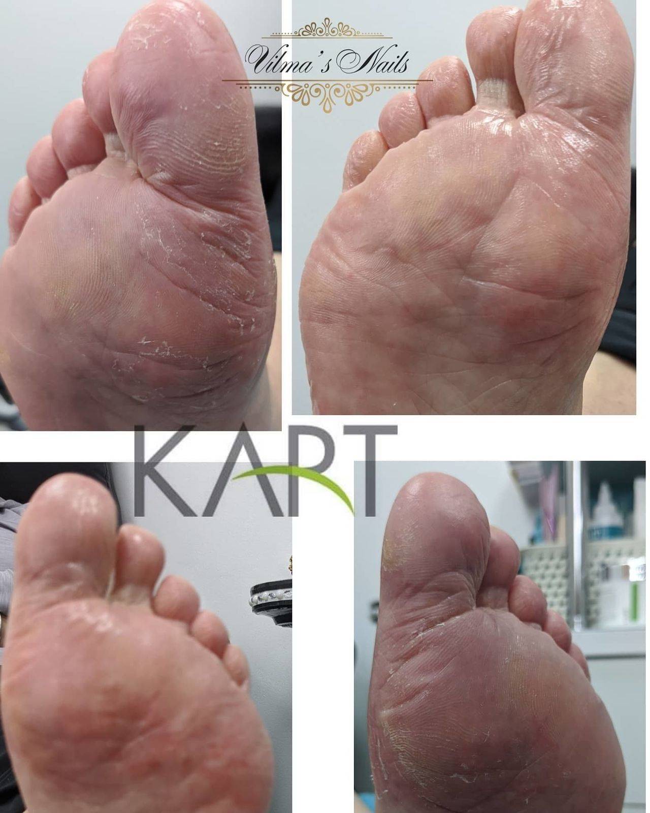 1st Kart Pedicure Treatment