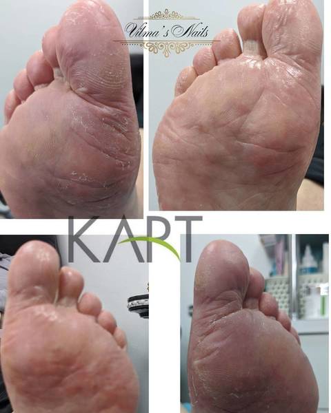 1st Kart Pedicure Treatment