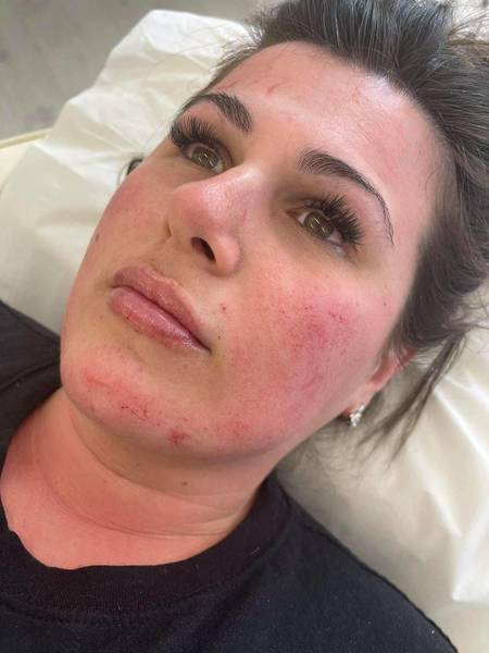 1.1ml Lip Enhancement 